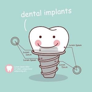 Dental Implant History