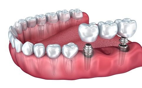 Anaheim Dental Implants Orange County