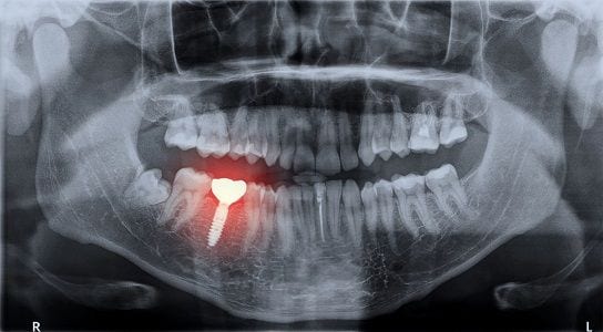 Orange County Dental Implant Surgery