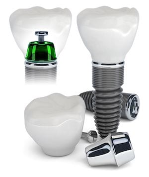 Orange County Mini Dental Implant