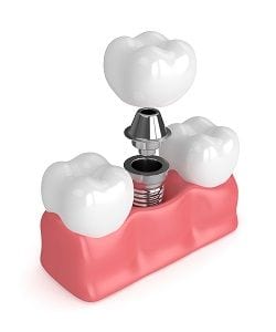 Best Anaheim Implant Dentistry