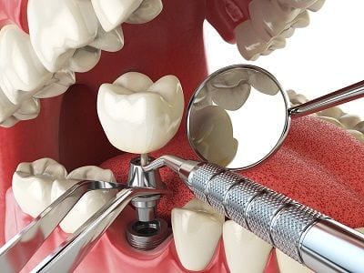 Anaheim Dental Implants