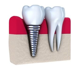 Laguna Woods Dental implants