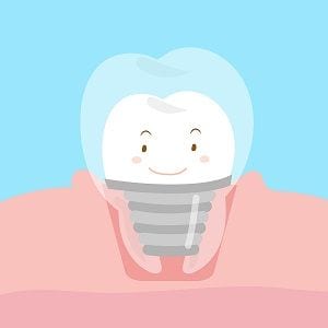 Anaheim Dental Implants Orange County