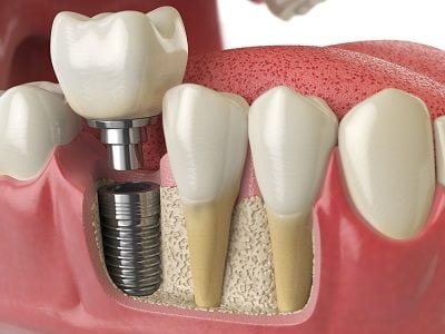 Ladera Ranch Dental Implants Orange County