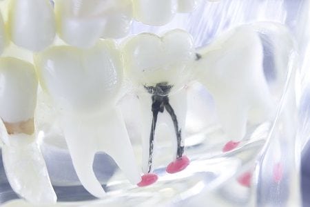 Laguna Woods Root Canal