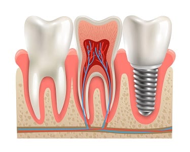 Orange County Multiple Tooth Replacement