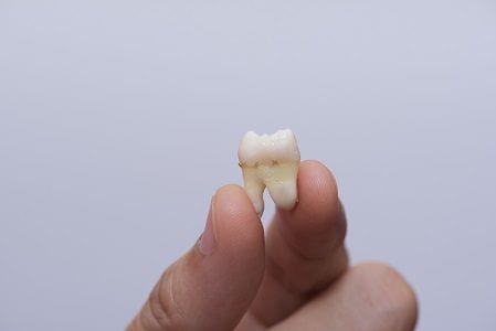 Anaheim Tooth Extraction Garden Grove