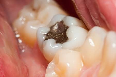 Orange County Dental Fillings Anaheim