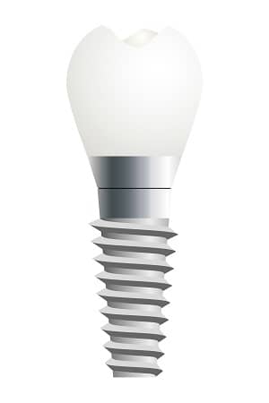 Orange County Dental Implants Anaheim
