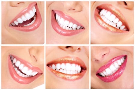 Orange County Teeth Whitening Ladera Ranch